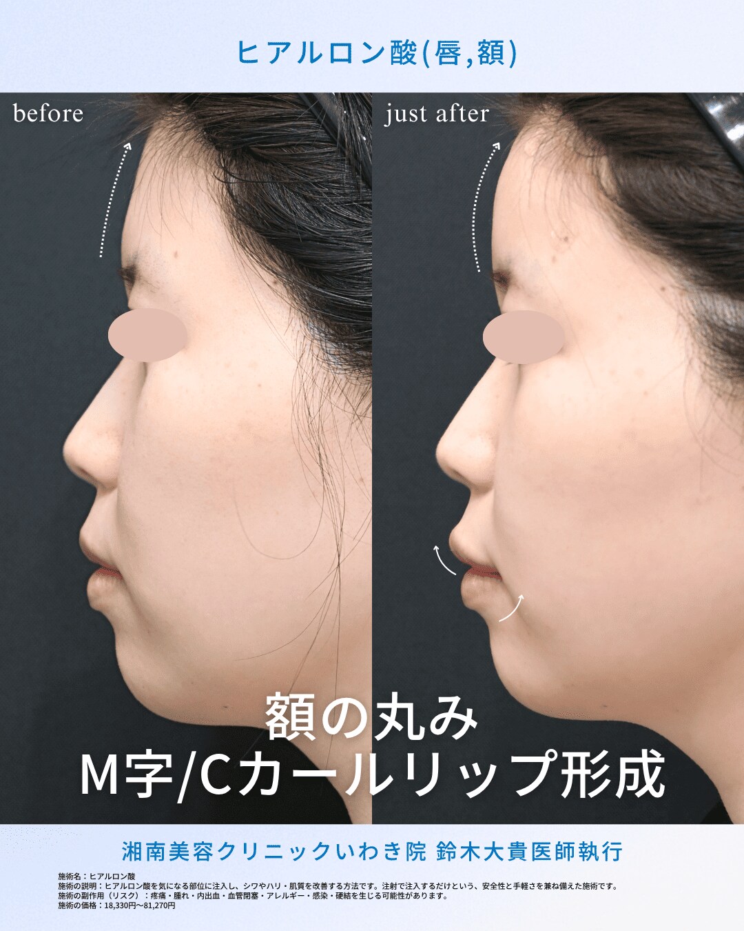 ミリ単位の繊細なデザインと精密な注入