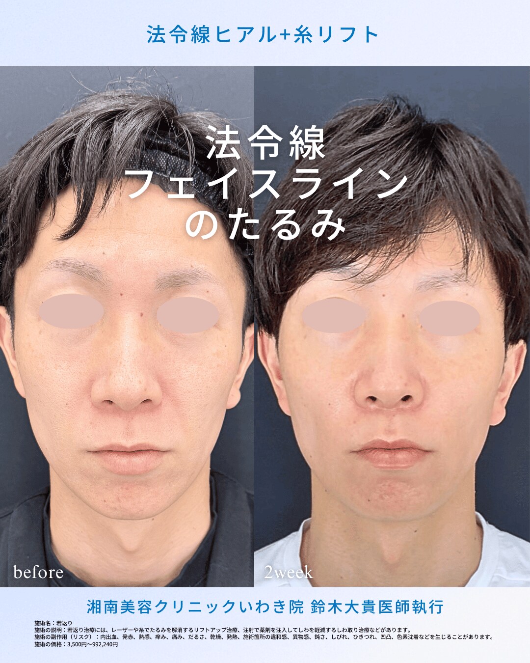 「切開無し」で叶える自然な若返り
