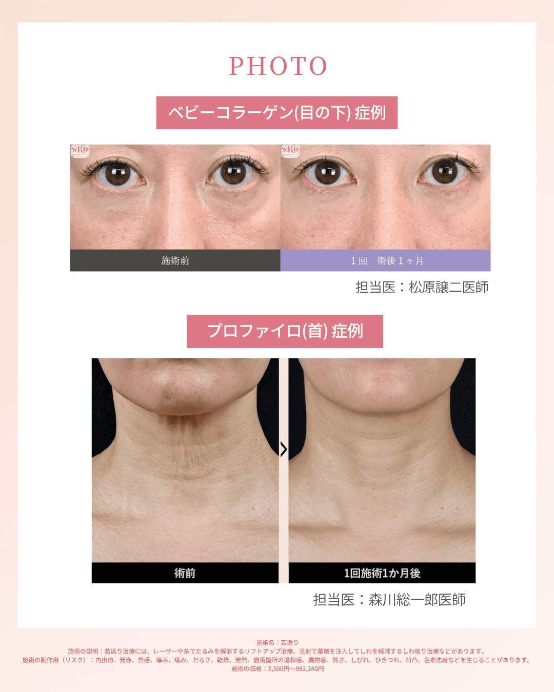 ベビーコラーゲン(目の下),プロファイロ(首)の症例【湘南美容クリニックいわき院】