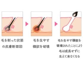 毛根を根本から破壊する「医療レーザー脱毛」とは？<br />
