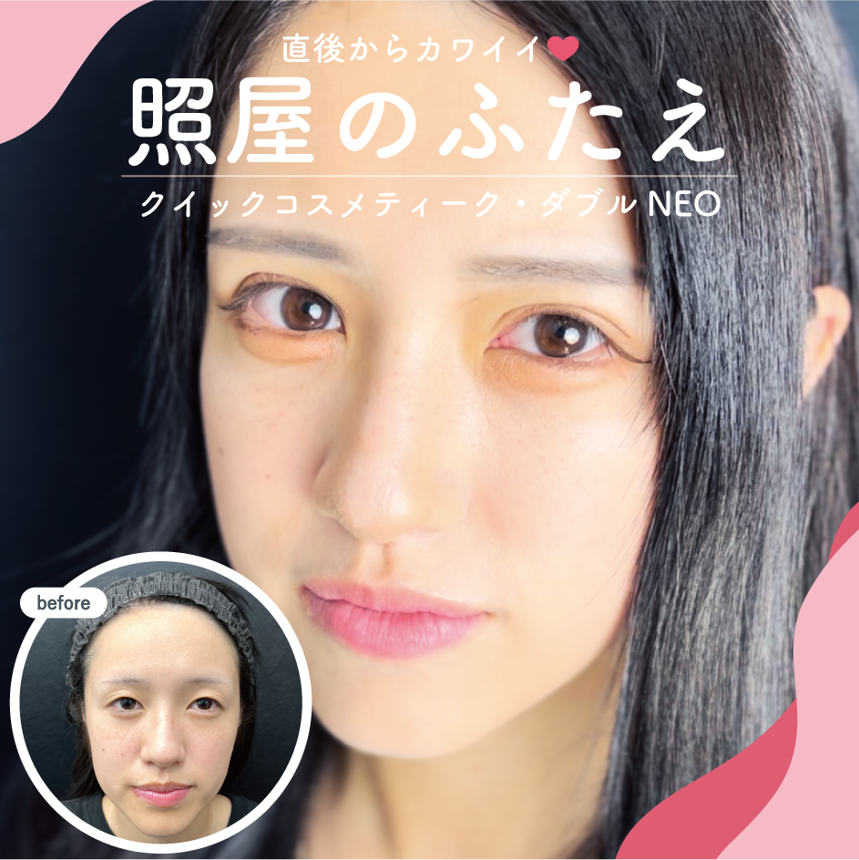 鹿児島で可愛い二重にするなら湘南美容クリニック鹿児島中央院！最小限のダウンタイムで最大限のカワイイをご提供！
