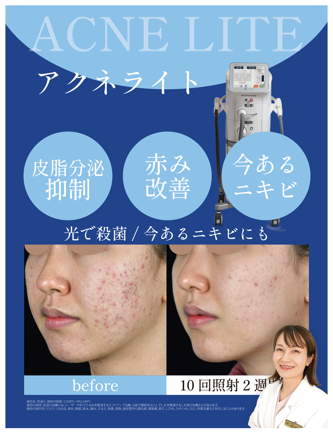 アクネライト