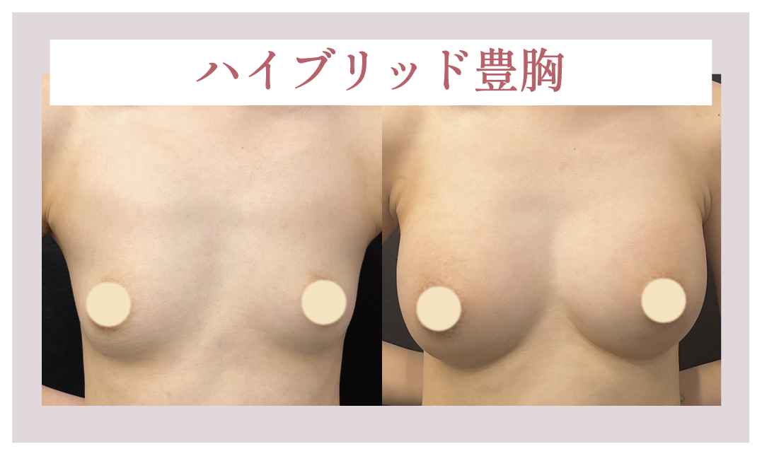 自然さ＋大きさどちらも重視の場合☝️