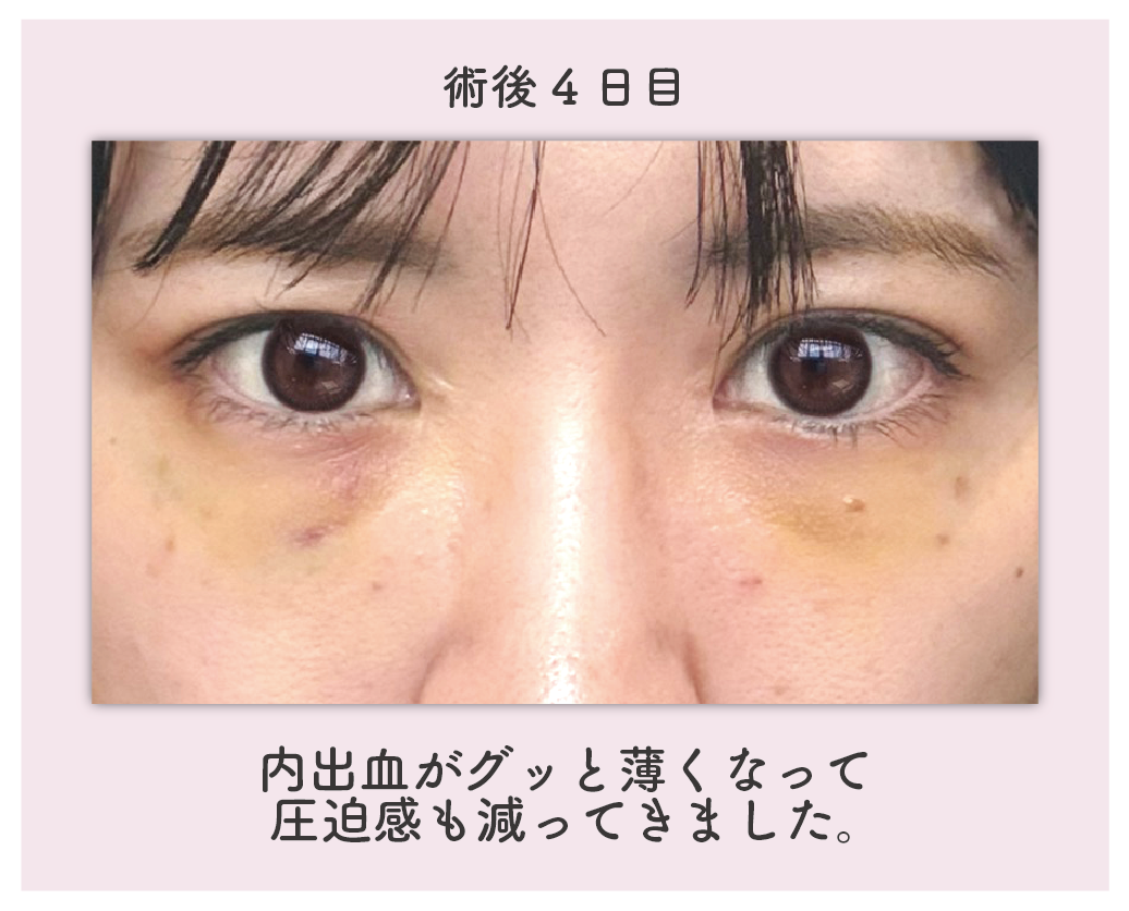 ダウンタイム：4日目