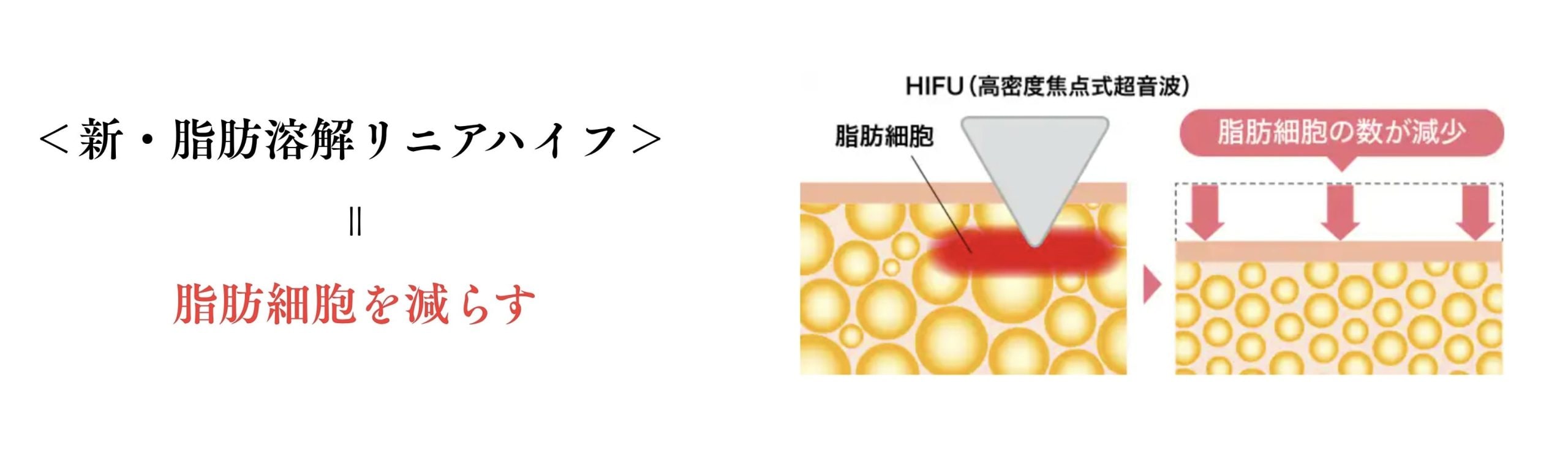 しつこい脂肪を溶かす「新・脂肪溶解リニアハイフ」<br />
