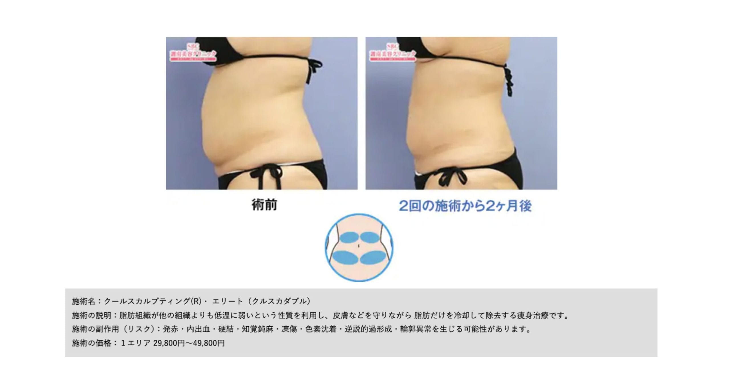 脂肪を冷却&破壊!!🧊<br />
落ちにくいお腹や二の腕の部分痩せをしたい方におすすめ‼️<br />
