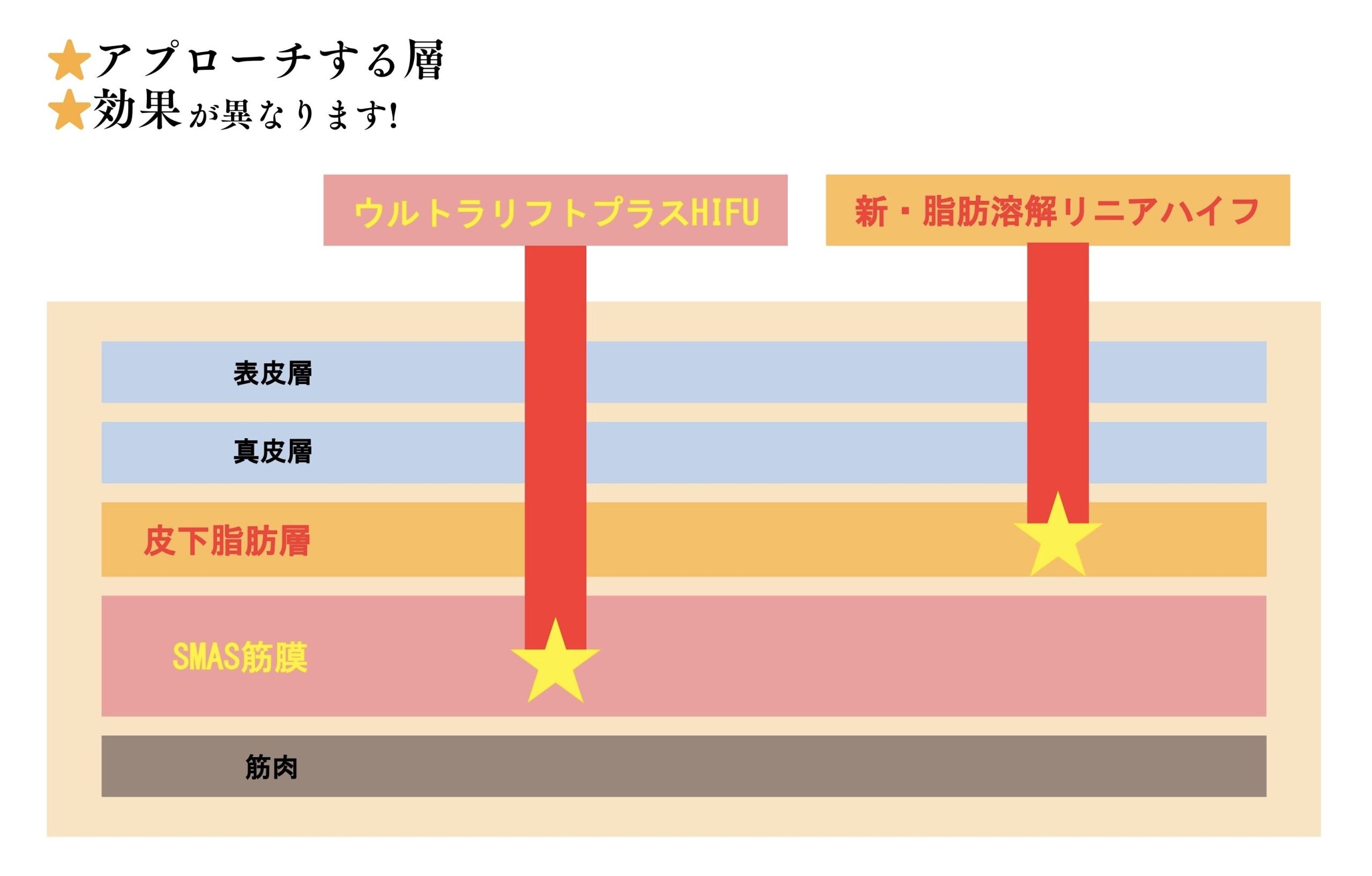 「ウルトラリフトプラスHIFU」と「新・脂肪溶解リニアハイフ」の違いって？