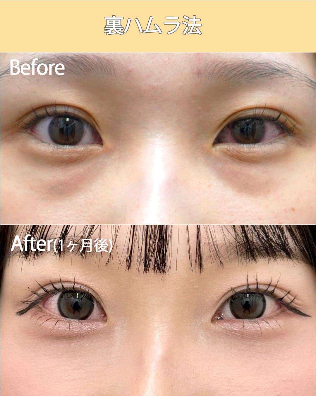 ③裏ハムラ法