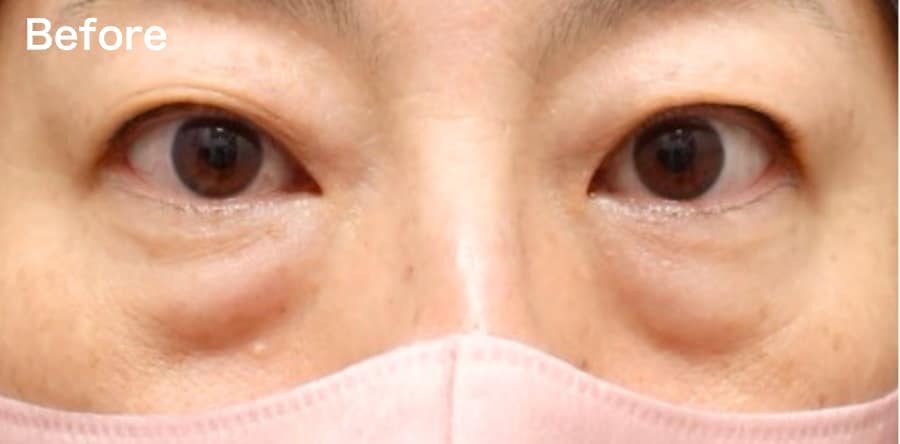 ”凹み””目の下のライン”が気になる方!