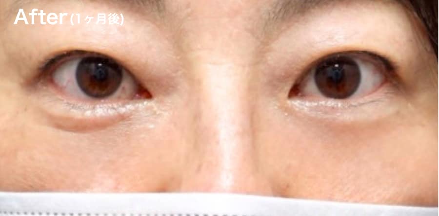 ”凹み””目の下のライン”が気になる方!