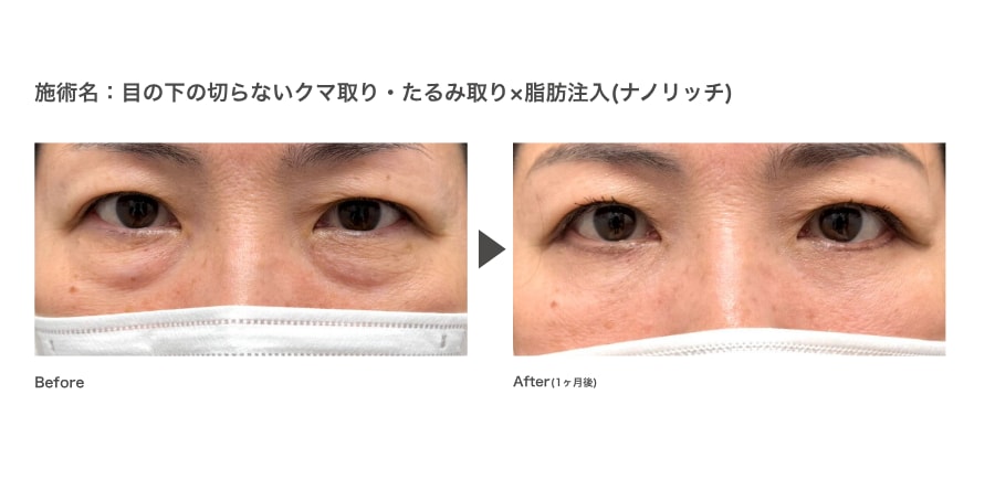 切開ハムラ