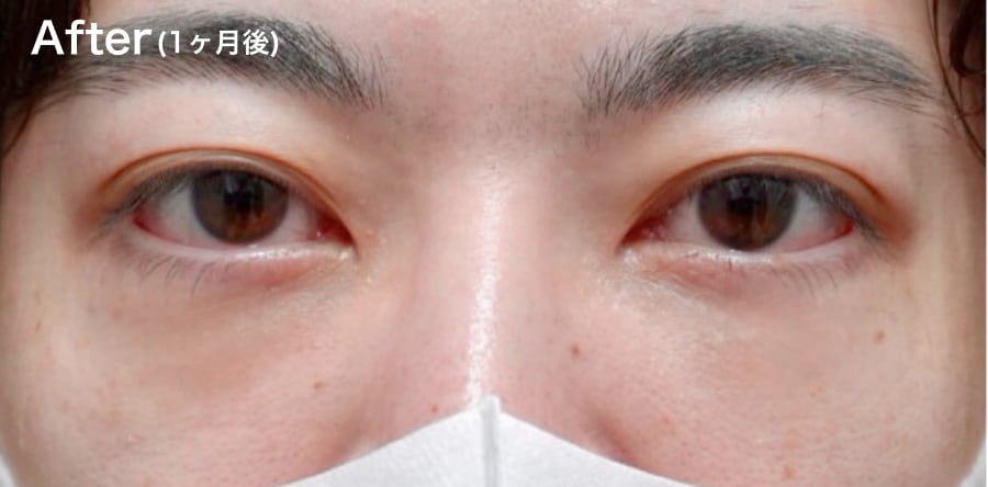”凹み””目の下のライン”が気になる方！