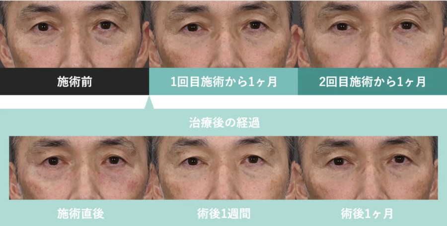 ☑️脂肪のタイトニング