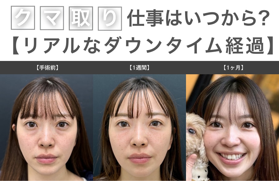 【裏ハムラ法】仕事復帰はいつから？≪クマ取り名医≫上岡利一医師の“腫れさせない”1週間経過を公開