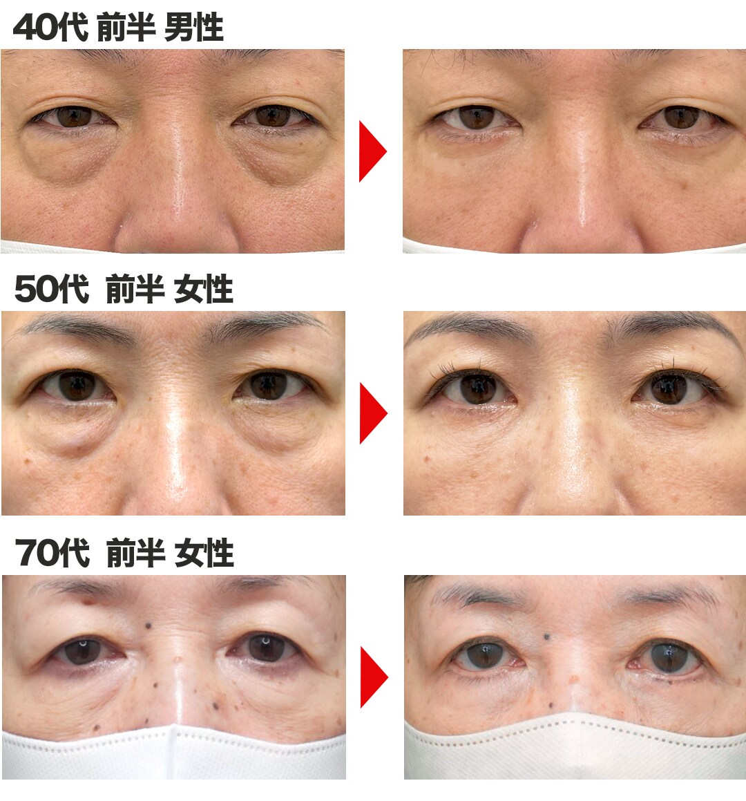 切開ハムラ集