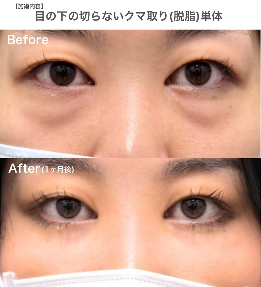 脱脂集