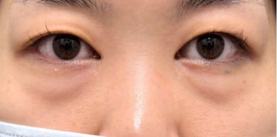 【黒クマ（影クマ）】の場合