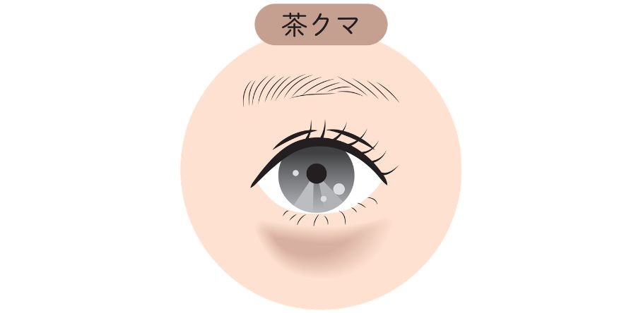 【茶クマ（色素沈着）】の場合
