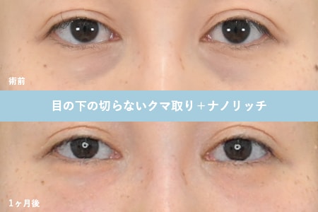 ナノリッチ<br />
☆青グマや細かい小ジワがある方に！