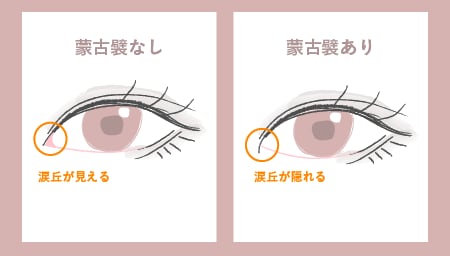 蒙古襞があっても意外とできます