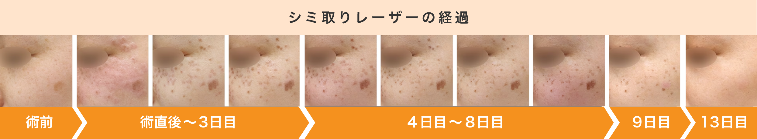シミ取りレーザー