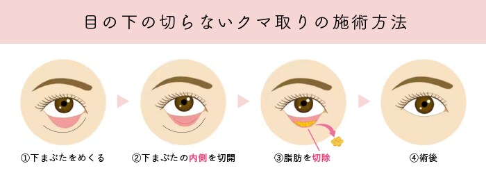 目の下の切らないクマ・たるみ取り