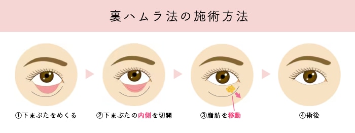 裏ハムラ法
