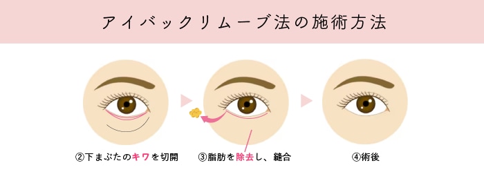 アイバックリムーブ法