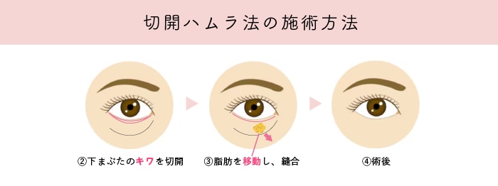 切開ハムラ法