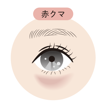 【赤クマの治療】<br />
