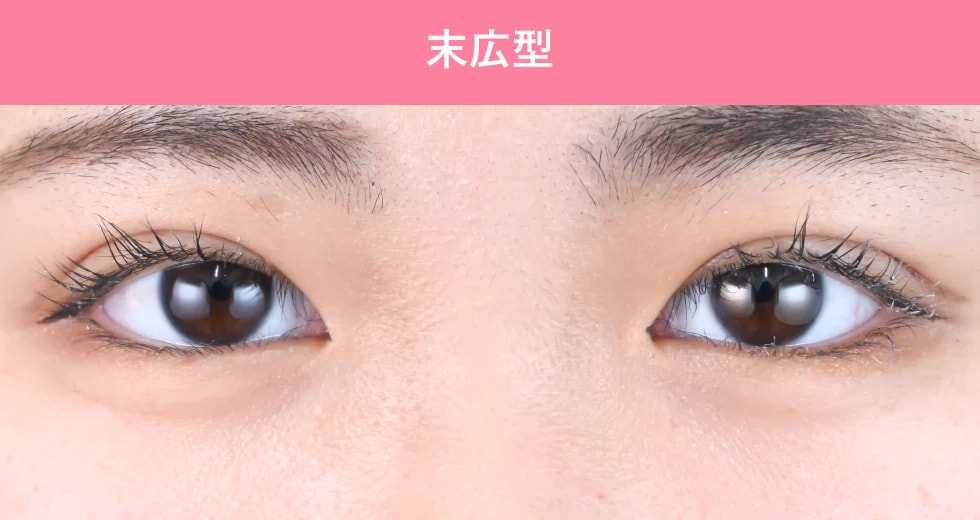 {クイックコスメティークダブル} {10代}  {女性} の術後の症例写真