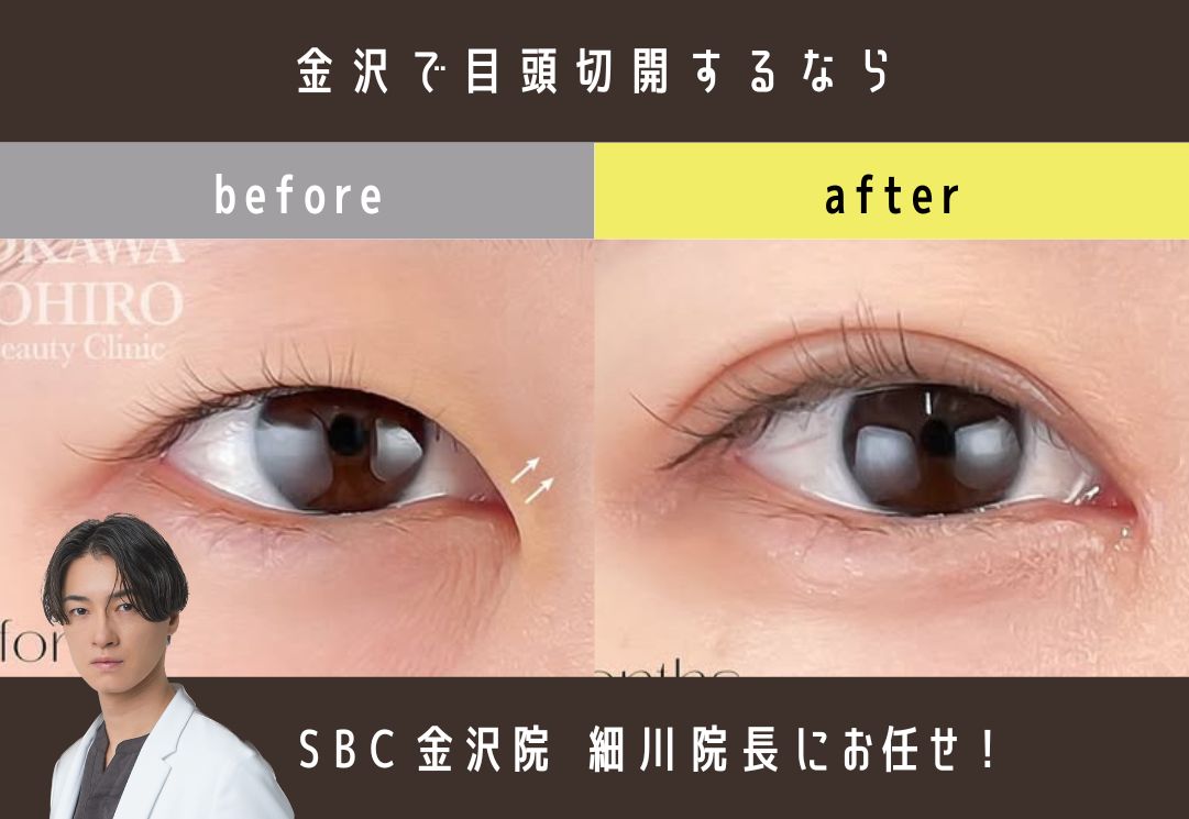 SBC金沢院の「目頭切開×二重整形」で離れ目・蒙古ひだを解消！金沢で憧れの平行二重に