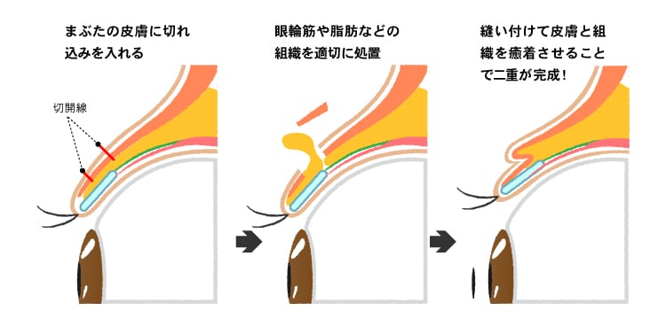 ”切開”するから腫れが激しくなる