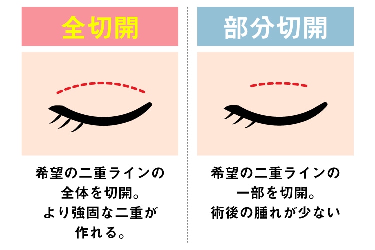 【全切開二重】を選択