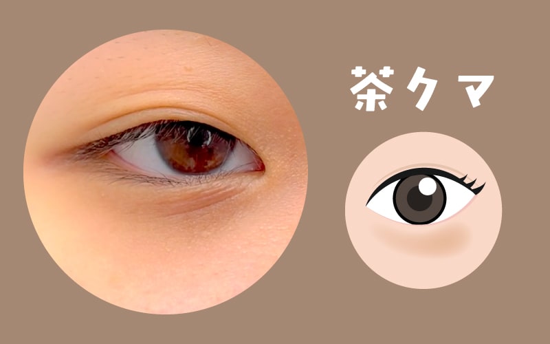 ❷茶クマ：皮膚の色素沈着によるタイプ