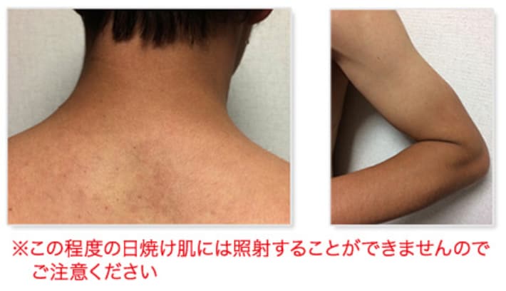 どのくらいの肌の色だとレーザー治療ができませんか？
