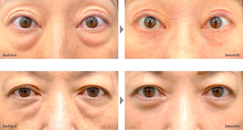 50代 | 切開ハムラ