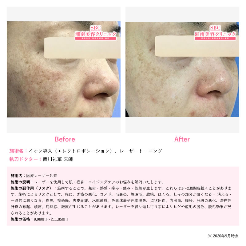 レーザートーニングって？