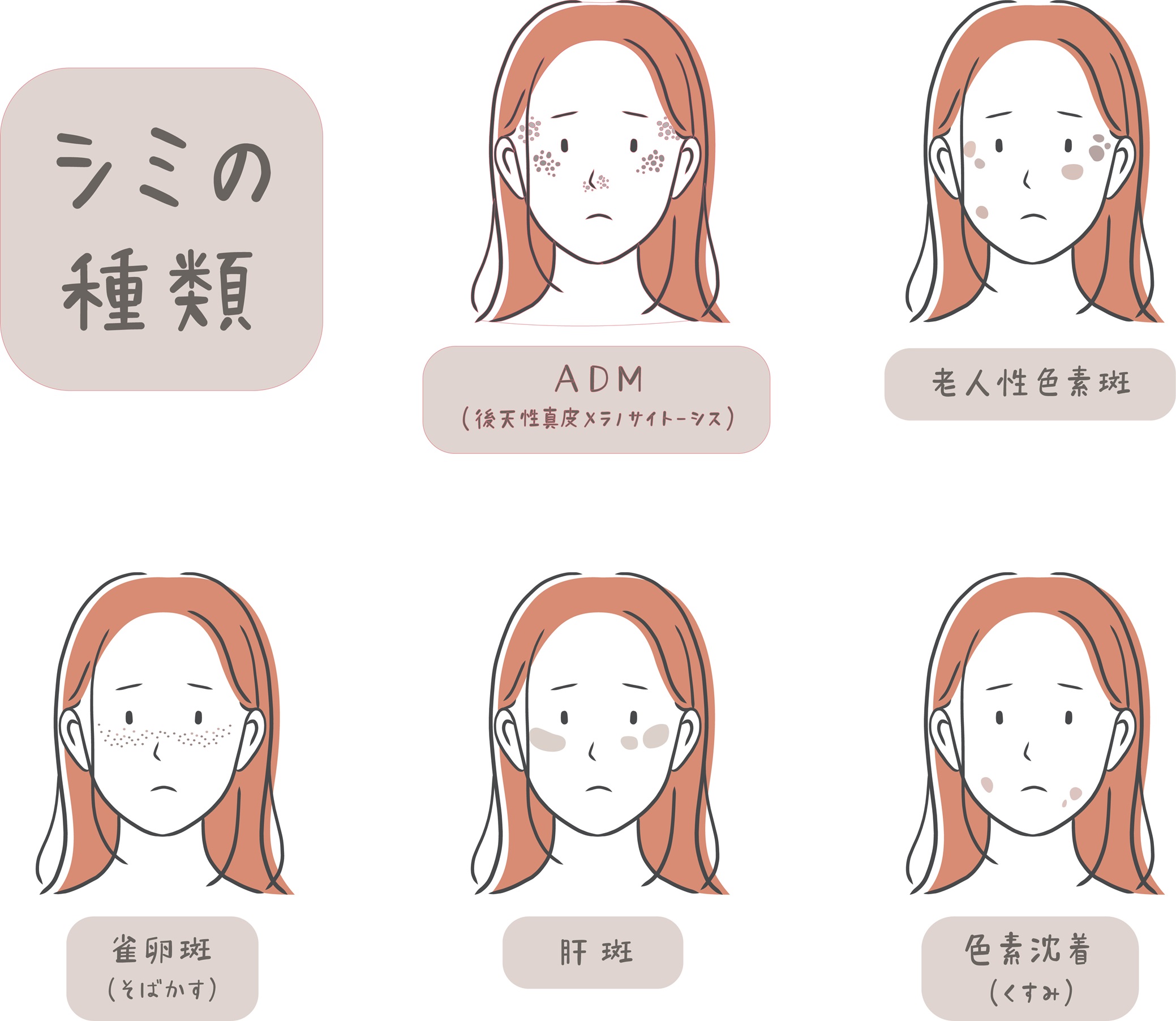 老人性色素斑