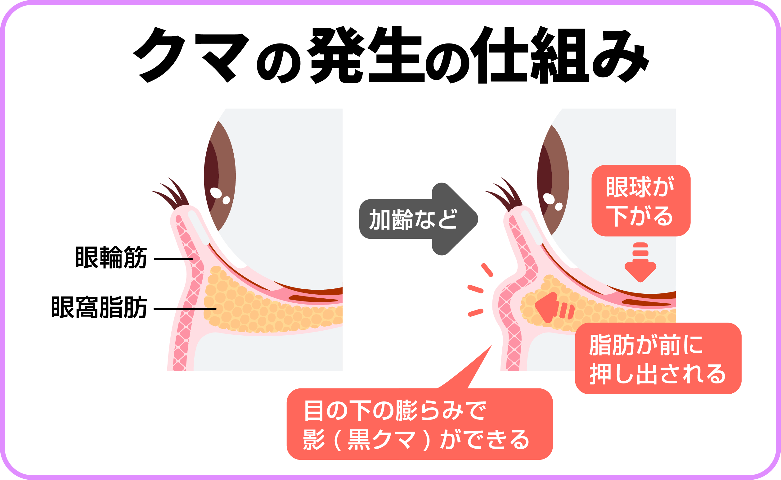クマ取り治療の種類