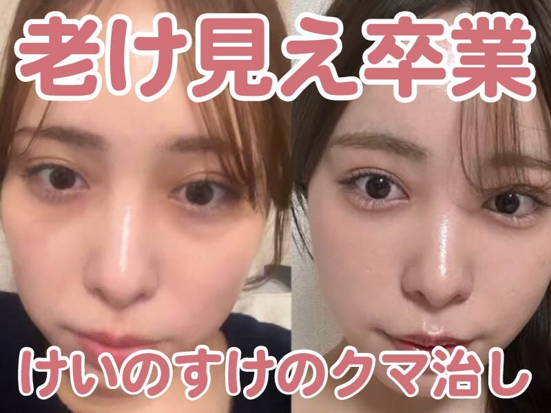 「疲れてる？」はもう言わせない！【SBC川崎院】佐藤けいのすけ院長のクマ取り治療で老け見え卒業！