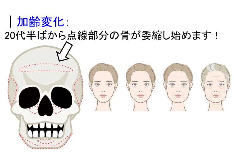 原因②：骨が縮んでいる