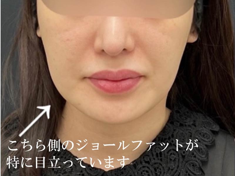 ジョールファット除去すると頬がコケる噂って本当？