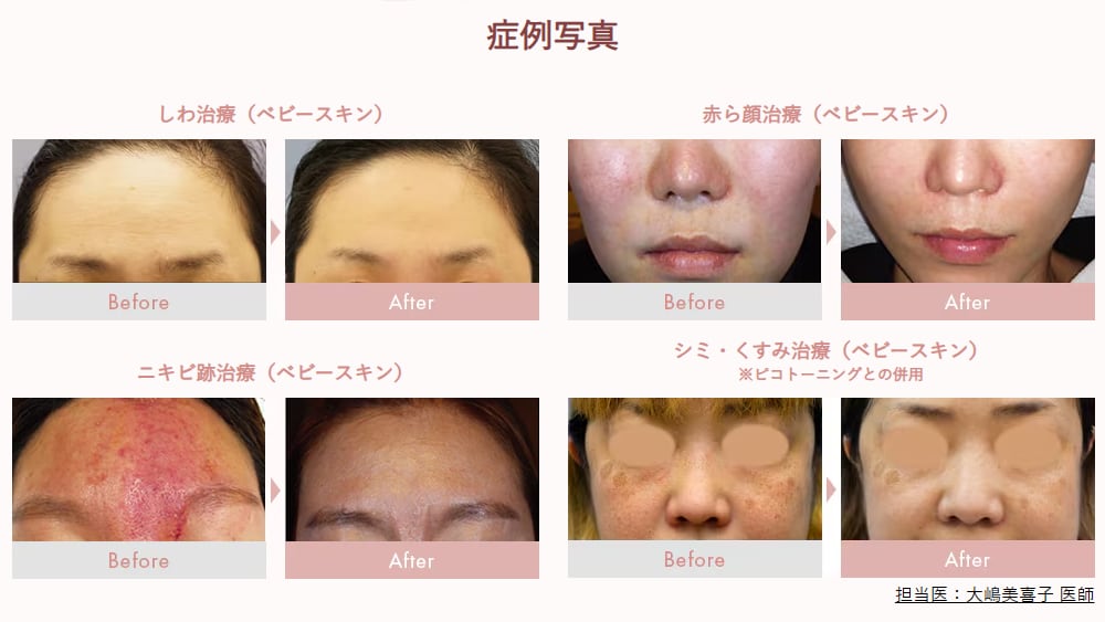 エレクトロポレーションは幅広い肌悩みにアプローチ出来ます✨