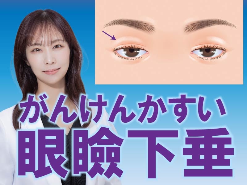 【まぶたが重い・下がる方へ】眼瞼下垂手術なら形成外科専門医・吉田佳奈【目の開きを改善する高度な技術】