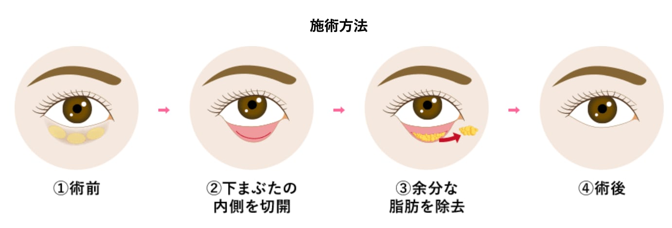クマ治療 各術式の詳しい解説