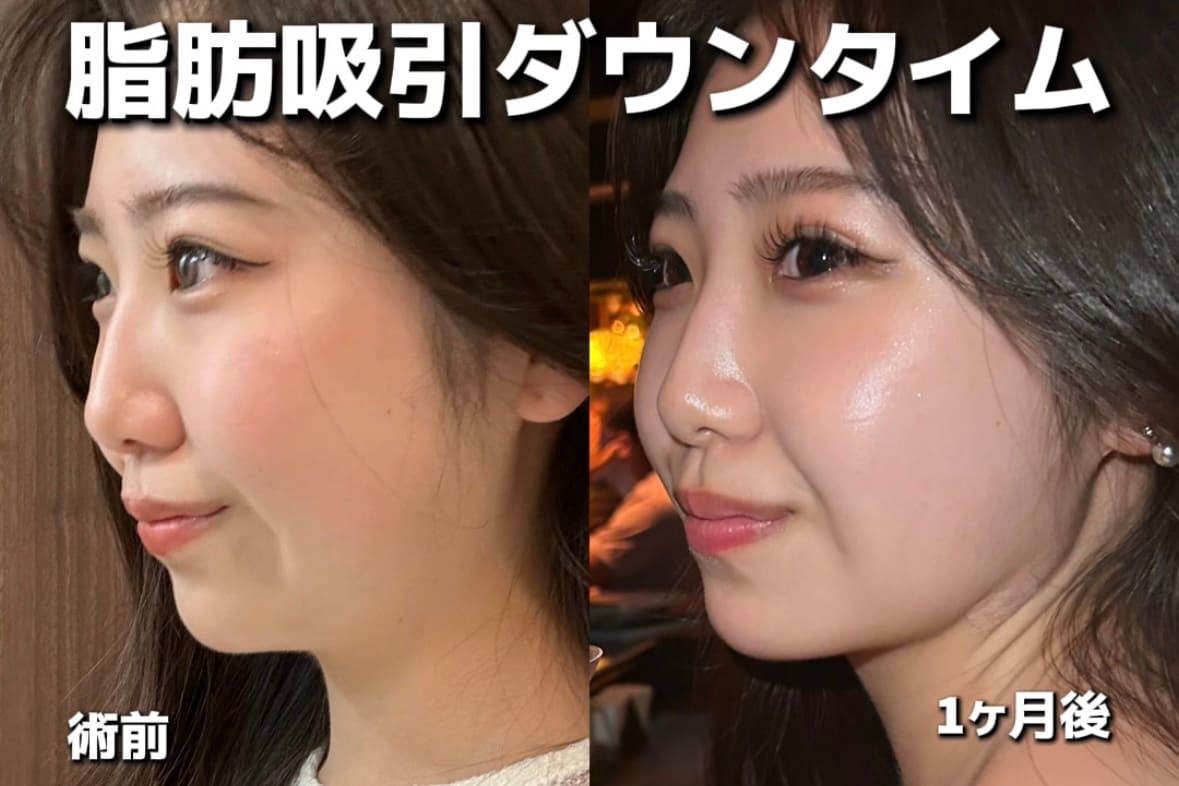 顔の脂肪吸引後の仕事復帰はいつから？1ヶ月のダウンタイム経過レポで腫れや内出血のリアルを公開