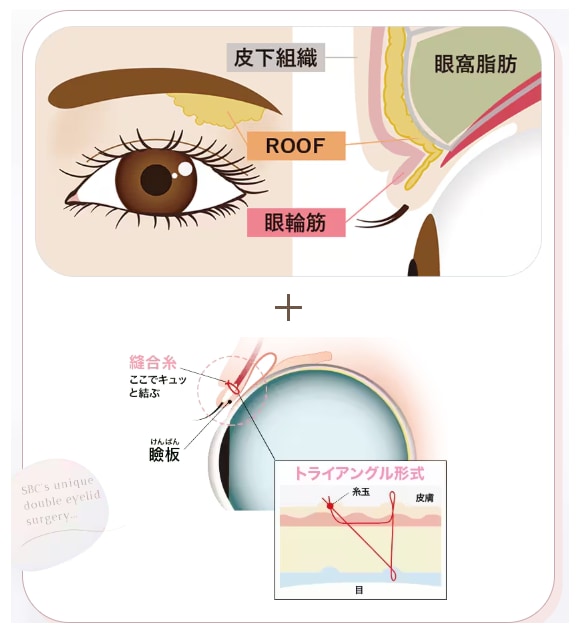 自然癒着法ってそもそも何？
