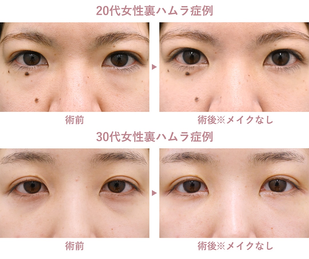 裏ハムラ症例