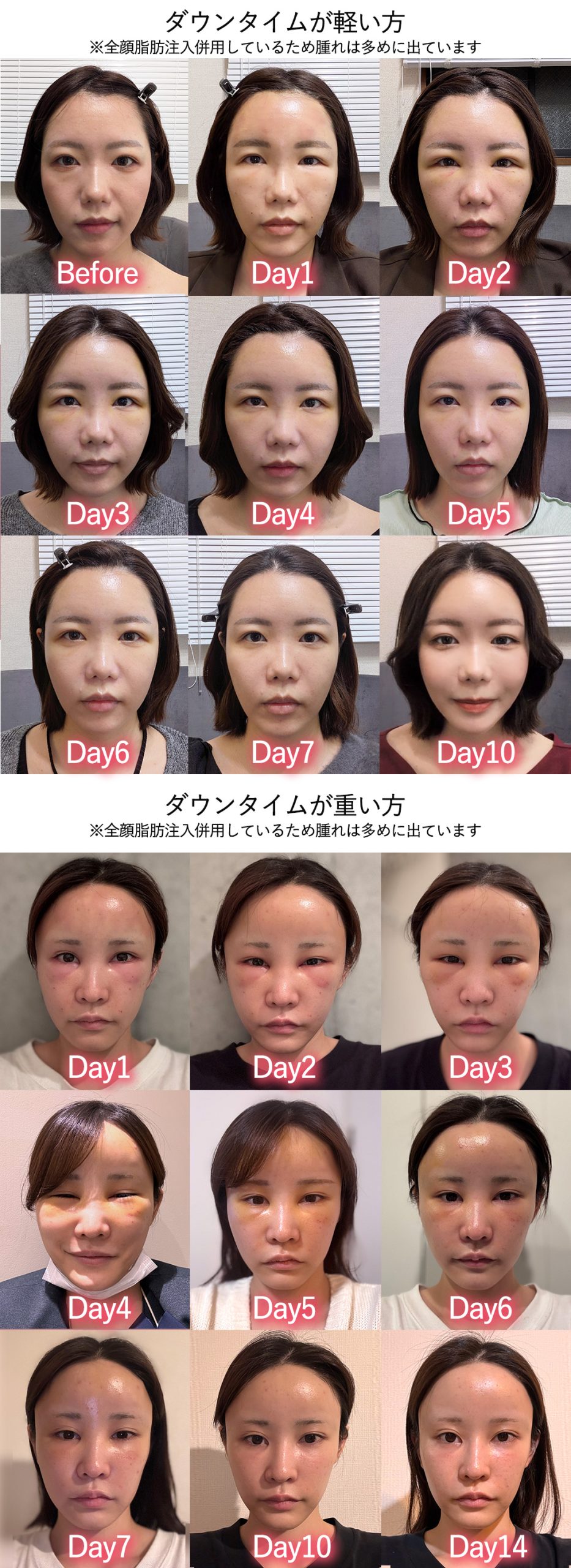 目の下の切らないクマたるみ取りのダウンタイム症例
